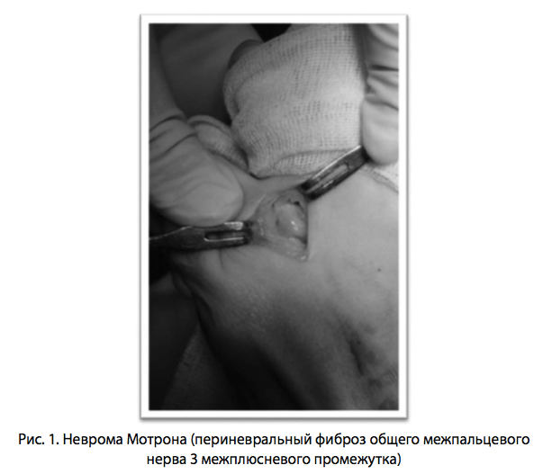 Рис. 1. Неврома Мотрона