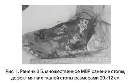 Рис. 1. Раненый Б. множественное МВР