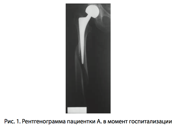Рис. 1. Рентгенограмма пациентки А. в момент госпитализации
