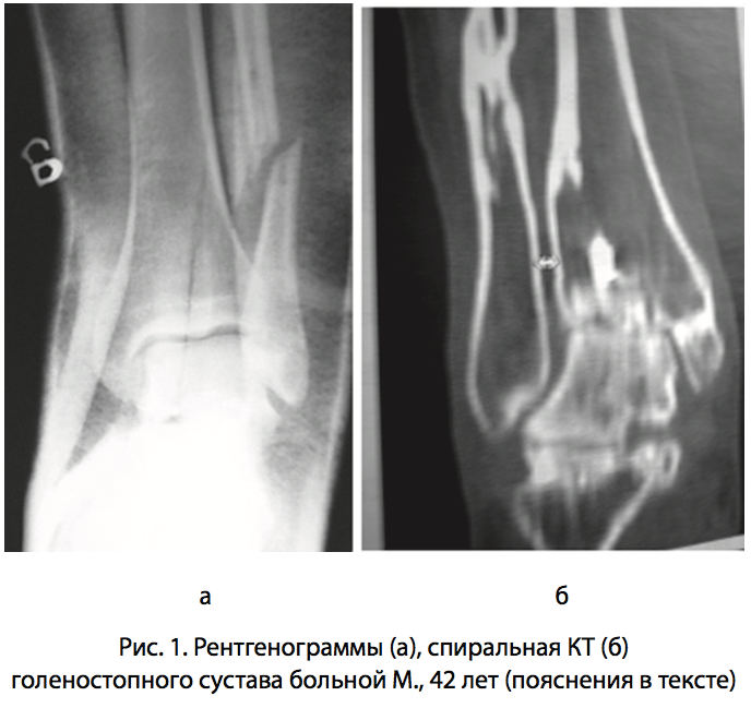 Рис. 1. Рентгенограммы