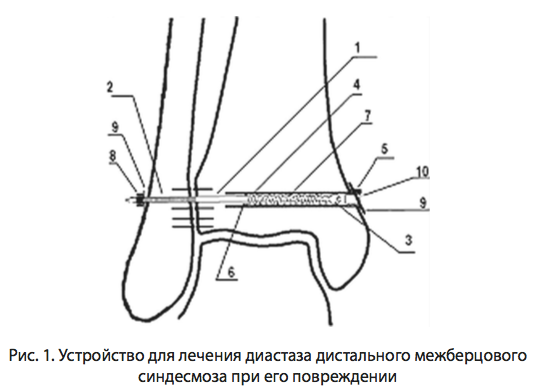 Рис. 1. Устройство для лечения диастаза