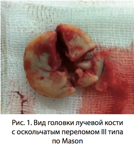 Рис. 1. Вид головки лучевой кости