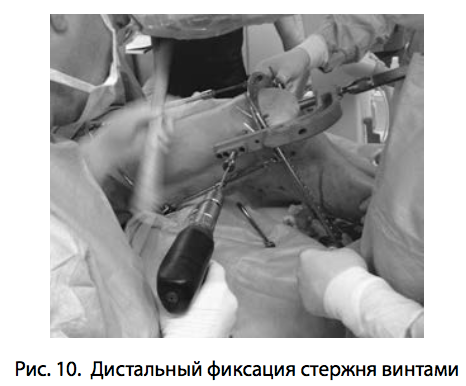 Рис. 10. Дистальный фиксация стержня винтами