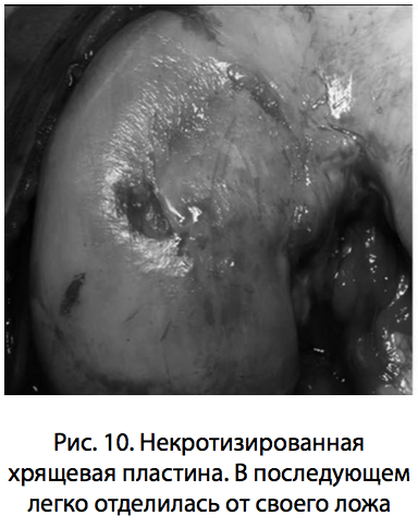 Рис. 10. Некротизированная хрящевая пластина