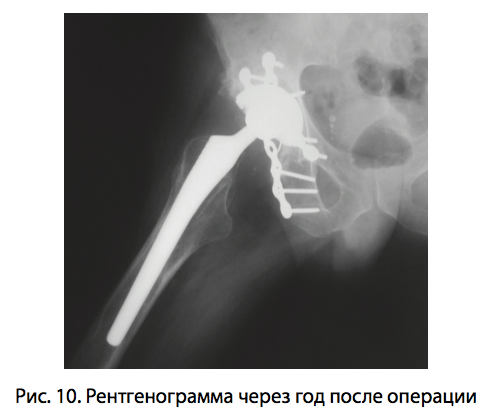 Рис. 10. Рентгенограмма через год