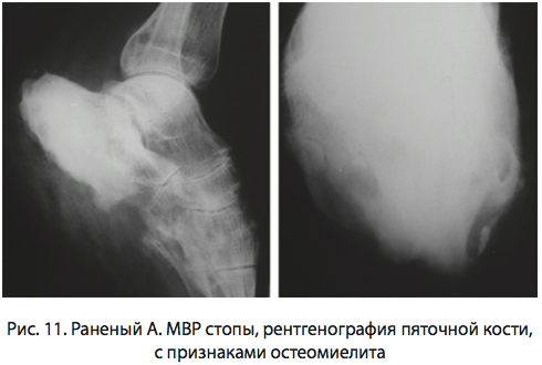 Рис. 11. Раненый А. МВР стопы рентгенография