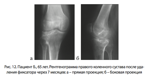 Рис. 12. Пациент Б., 65 лет. Рентгенограмма