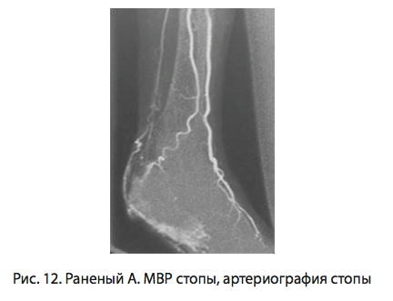 Рис. 12. Раненый А. МВР стопы артериография стопы