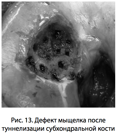 Рис. 13. Дефект мыщелка после туннелизации