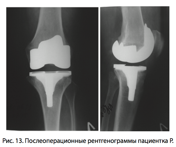 Рис. 13. Послеоперационные рентгенограммы пациентка Р