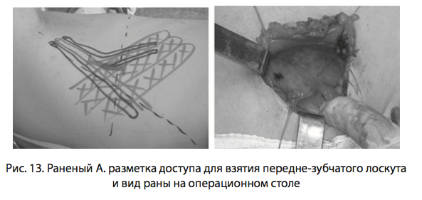 Рис. 13. Раненый А. разметка доступа