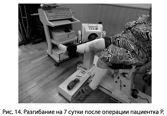 Рис. 14. Разгибание на 7 сутки после