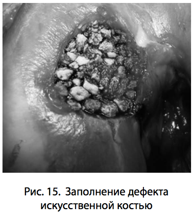 Рис. 15. Заполнение дефекта искусственной костью