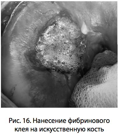 Рис. 16. Нанесение фибринового клея