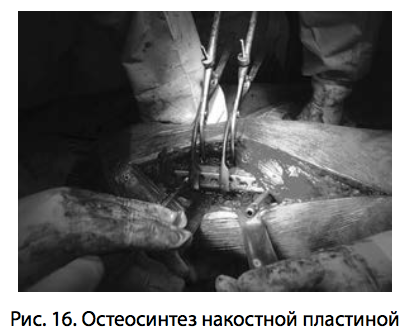 Рис. 16. Остеосинтез накостной пластиной