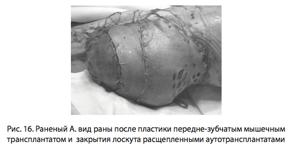 Рис. 16. Раненый А. вид раны после