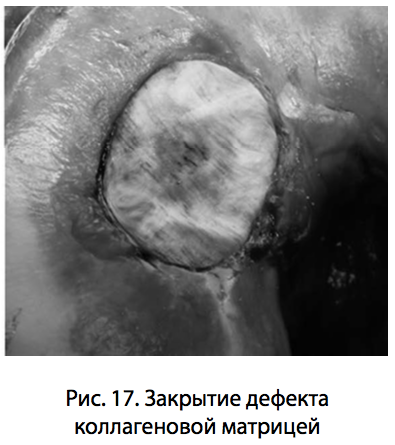 Рис. 17. Закрытие дефекта коллагеновой матрицей