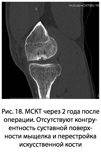 Рис. 18. МСКТ через 2 года