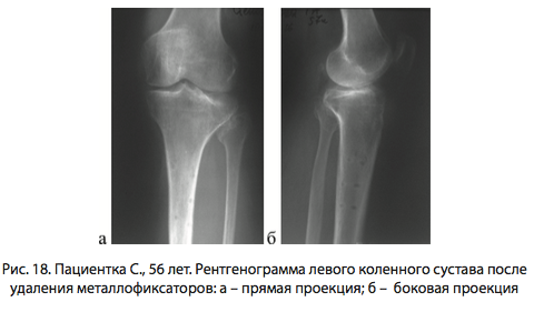 Рис. 18. Пациентка С., 56 лет. Рентгенограмма