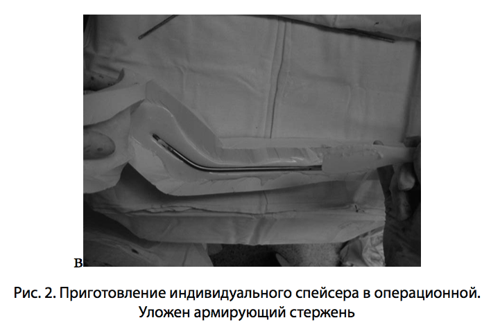 Рис. 2. Приготовление индивидуального спейсера