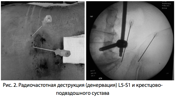 Рис. 2. Радиочастотная деструкция