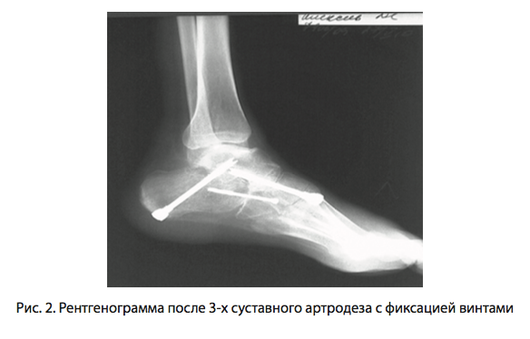 Рис. 2. Рентгенограмма после