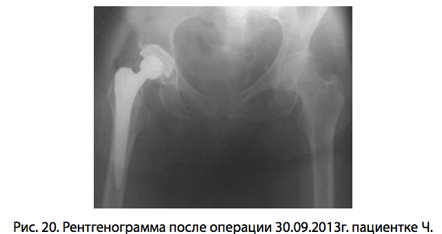 Рис. 20. Рентгенограмма после операции