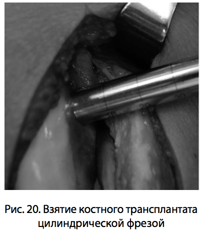 Рис. 20. Взятие костного трансплантата цилиндрической фрезой