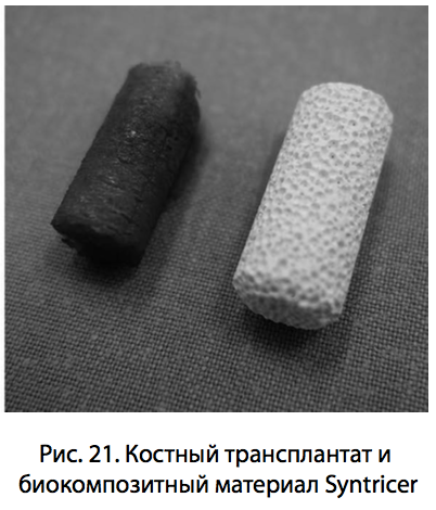 Рис. 21. Костный трансплантат и биокомпозитный материал Syntricer