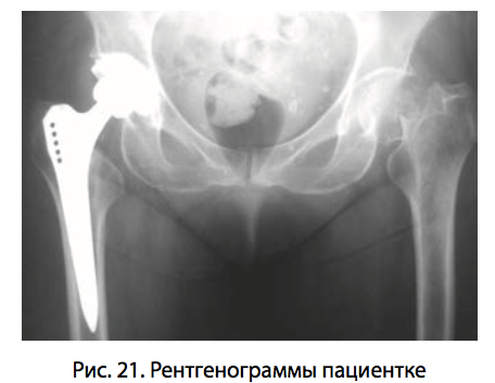 Рис. 21. Рентгенограммы пациентке