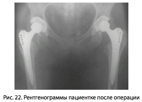 Рис. 22. Рентгенограммы пациентке после