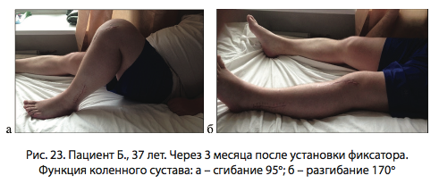 Рис. 23. Пациент Б., 37 лет. Через 3 месяца