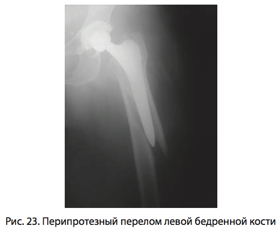 Рис. 23. Перипротезный перелом