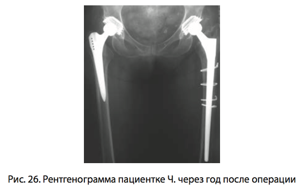 Рис. 26. Рентгенограмма пациентке Ч