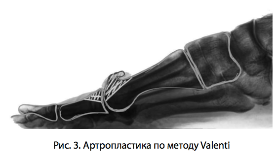 Рис. 3. Артропластика по методу Valenti