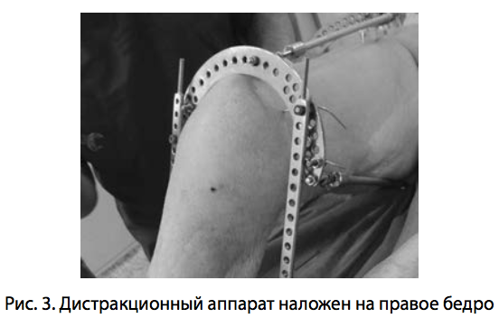 Рис. 3. Дистракционный аппарат