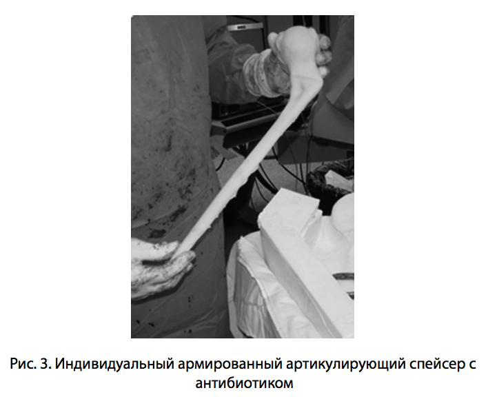 Рис. 3. Индивидуальный армированный артикулирующий спейсер