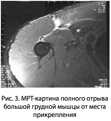Рис. 3. МРТ-картина полного отрыва