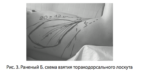 Рис. 3. Раненый Б. схема