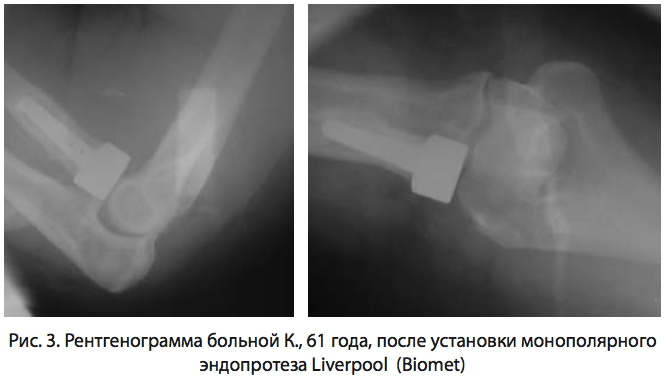 Рис. 3. Рентгенограмма больной К