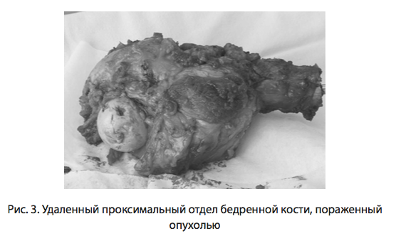 Рис. 3. Удаленный проксимальный отдел