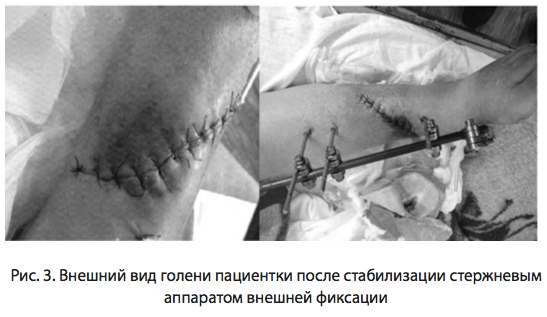 Рис. 3. Внешний вид голени пациентки после