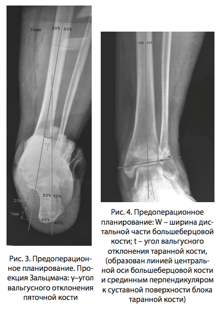 Рис. 3.4 Предоперационное планирование