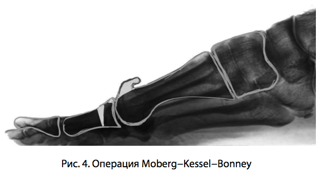 Рис. 4. Операция Moberg−Kessel−Bonney