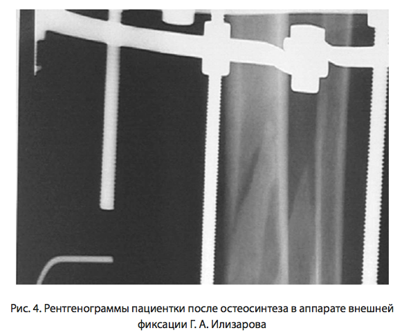 Рис. 4. Рентгенограммы пациентки после АВФ