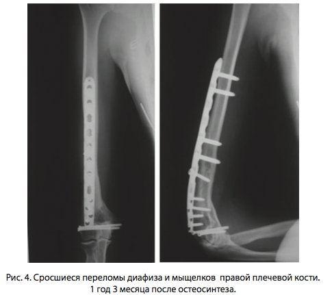 Рис. 4. Сросшиеся переломы диафиза и мыщелков правой плечевой кости. 1 год 3 месяца после остеосинтеза