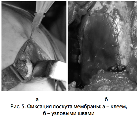 Рис. 5. Фиксация лоскута мембраны