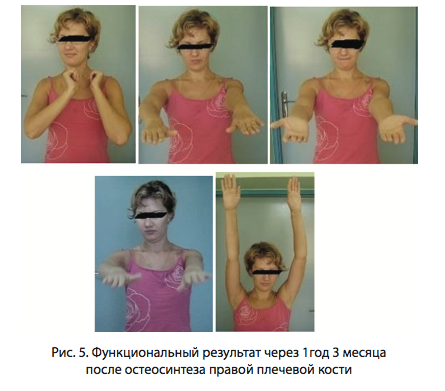Рис. 5. Функциональный результат через 1год 3 месяца после остеосинтеза правой плечевой кости