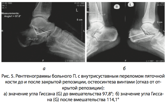 Рис. 5. Рентгенограммы больного П