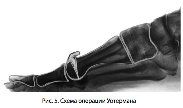 Рис. 5. Схема операции Уотермана